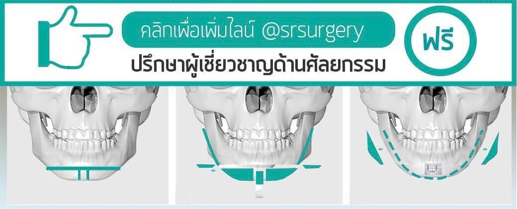 ลดโหนกแก้ม หมอกมล