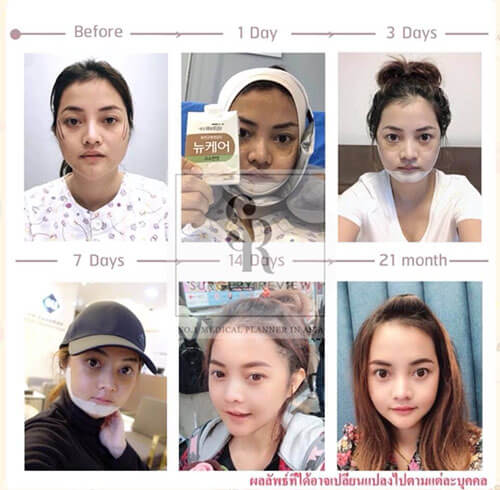ศัลยกรรมปรับโครงหน้า 3 จุด ลดโหนกแก้ม ตัดกราม และ วีไลน์ | Surgery Review ศัลยกรรมปรับโครงหน้า 3 จุด ลดโหนกแก้ม ตัดกราม และ วีไลน์ | Surgery Review