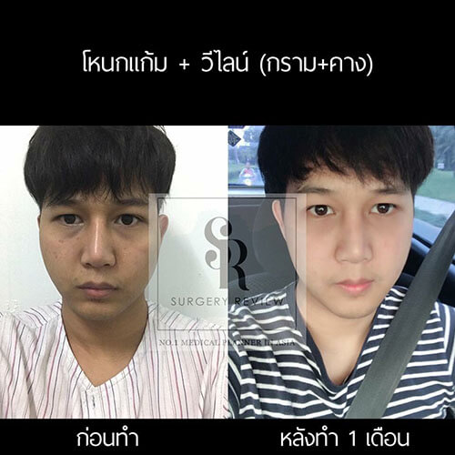 ปรับโครงหน้า ตัดกราม ลดโหนกแก้ม ผู้ชาย