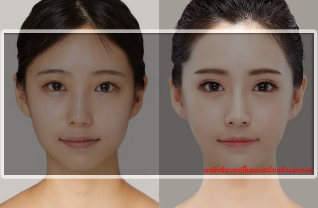 before-after-face-ศัลยกรรมใบหน้า-รีวิวศัลยกรรมหน้าเรียว
