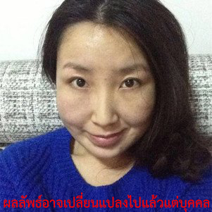ศัลยกรรม-ศัลยกรรม ใบหน้า-ทำ ศัลยกรรม