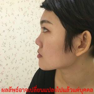 ทำ ศัลยกรรม-เสริมจมูก-ศัลยกรรม