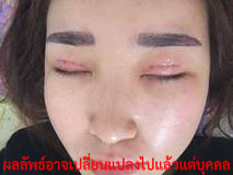 เสริมจมูก-ตา2ชั้น-ศัลยกรรม-ทำ ศัลยกรรม