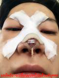 ศัลยกรรม-ทำจมูก-จมูกสวย-ทรงจมูก