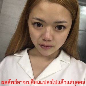 ทำจมูก-เสริมจมูก-ศัลยกรรม-ศัลยกรรม ใบหน้า