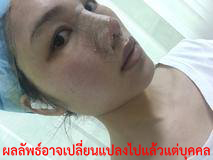 ศัลยกรรม ใบหน้า-ศัลยกรรม-ทำ ศัลยกรรม-ทำจมูก-เสริมจมูก