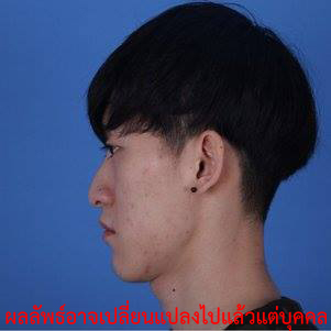 ศัลยกรรมใบหน้า-ทำจมูก-ทรงจมูก
