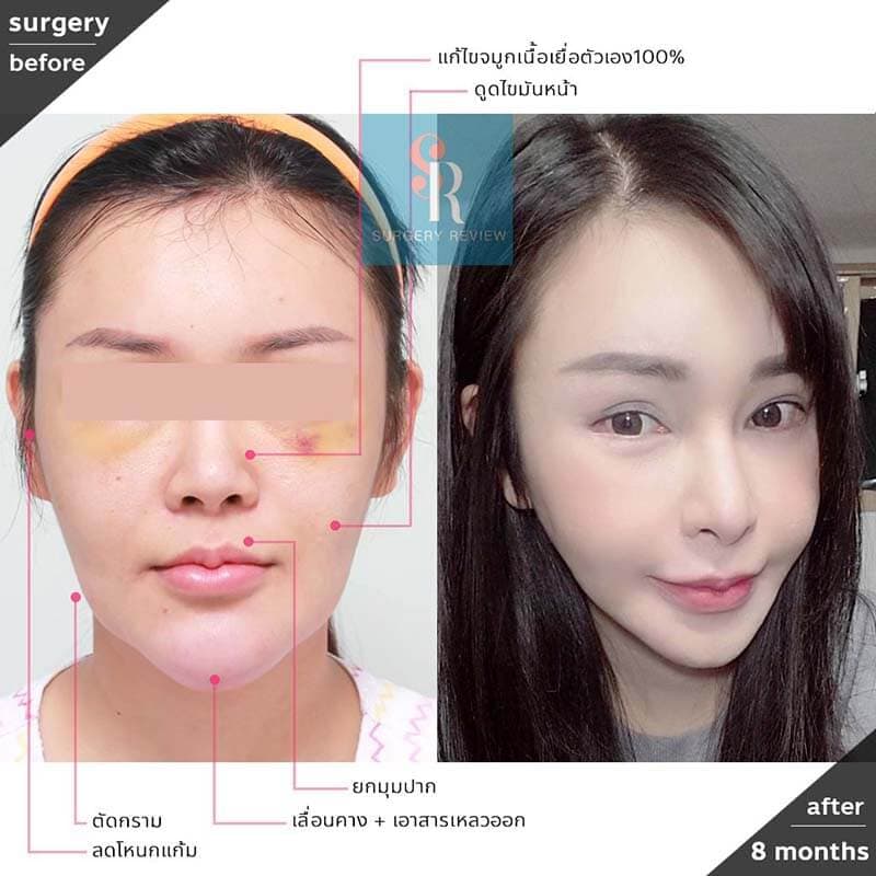 8 คลินิกศัลยกรรมยอดนิยม ของ คนเกาหลี ที่คุณต้องรู้ 2023 | Surgery Review