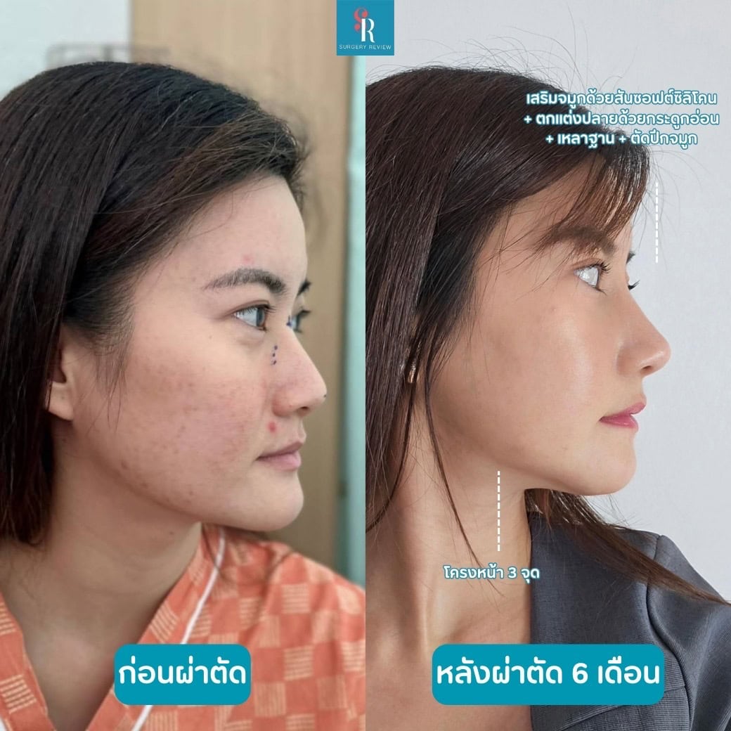 รีวิว รพ view โครงหน้า 3 จุด