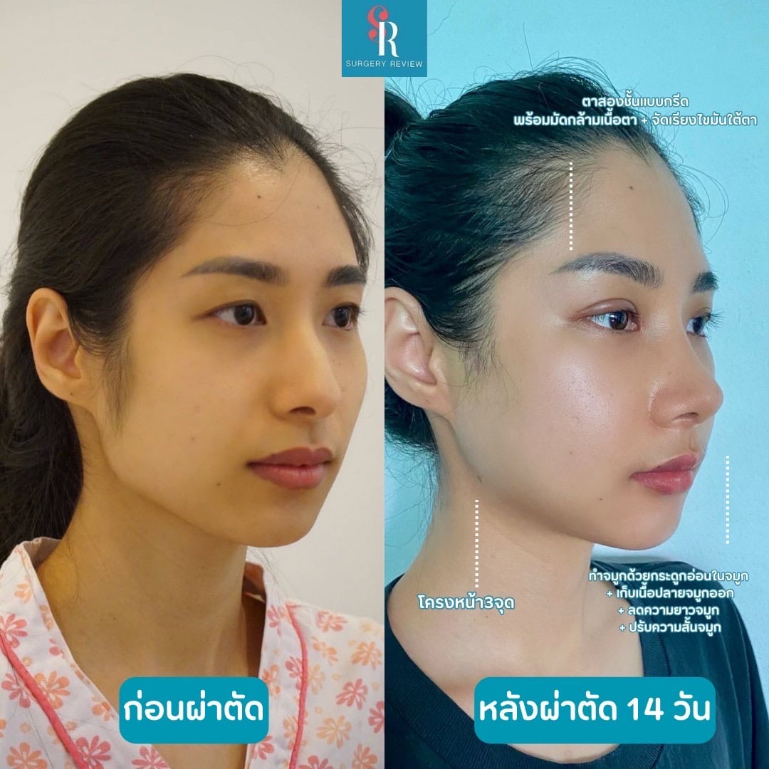 รีวิว ศัลยกรรมโครงหน้า รพ view