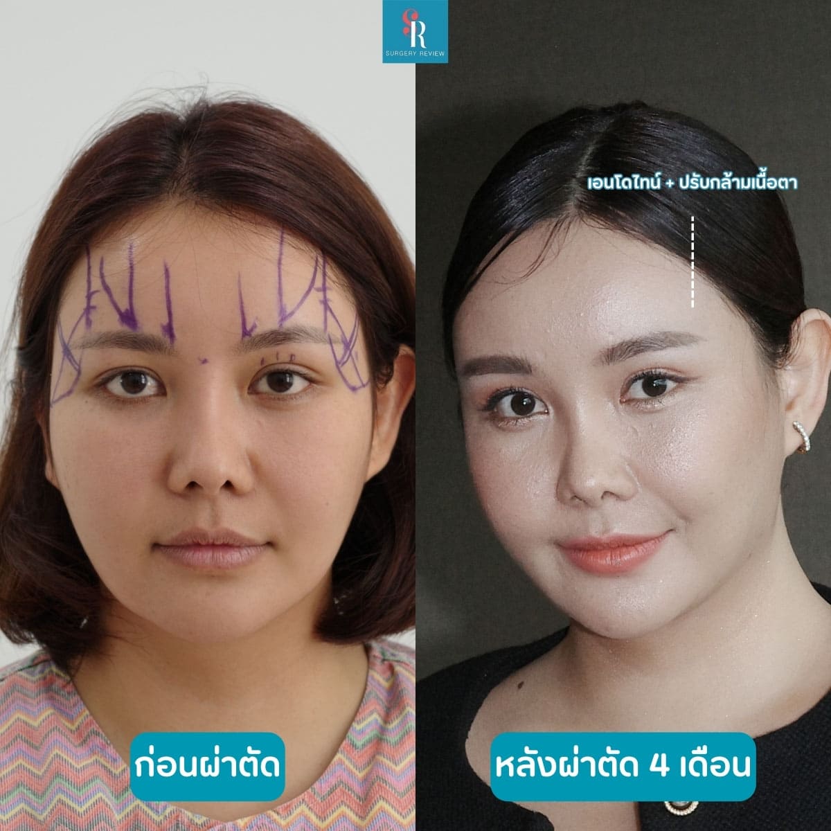 รีวิวทำ-endotine-ที่-Sui