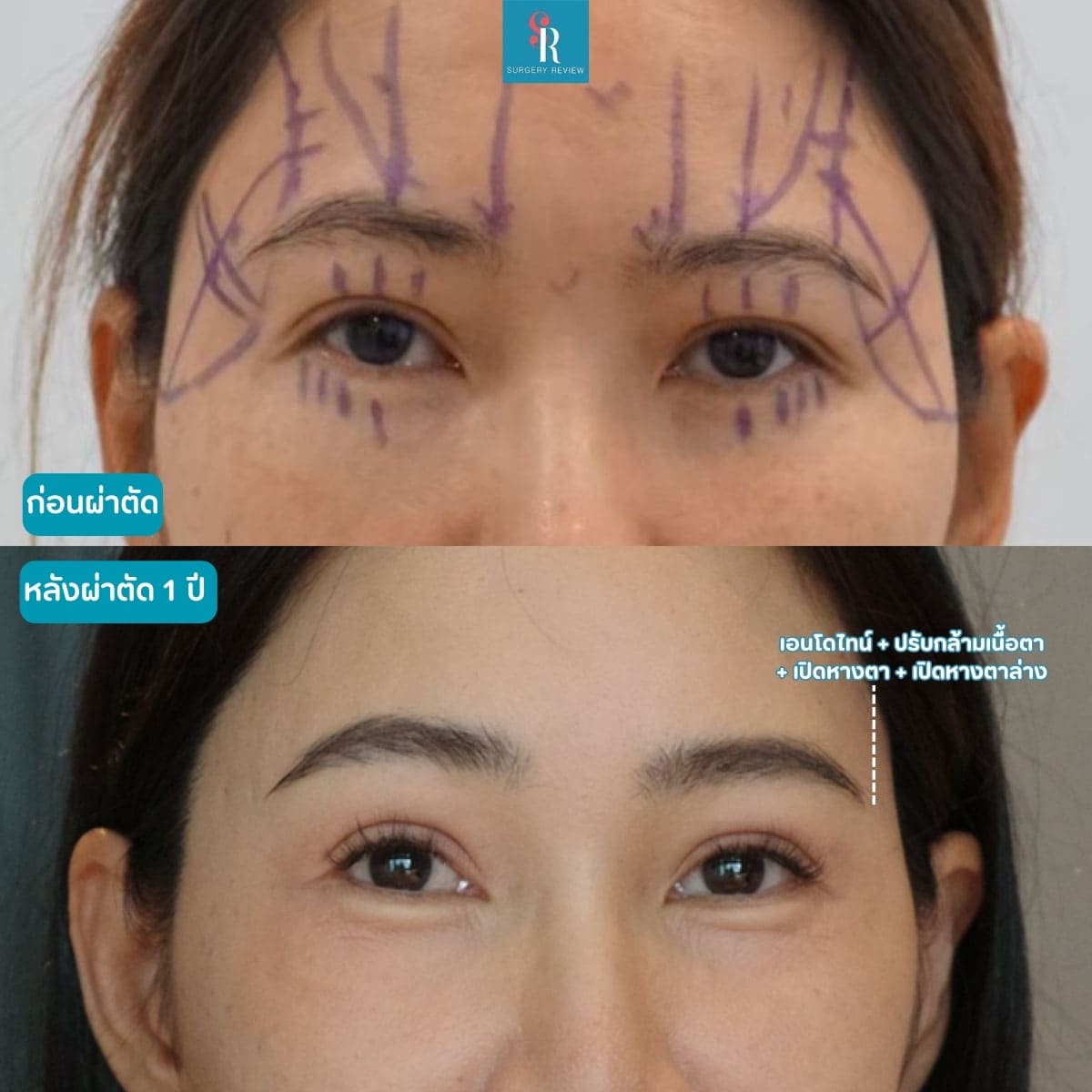 รีวิวทำตา-และ-เอนโดไทน์-ที่-Sui