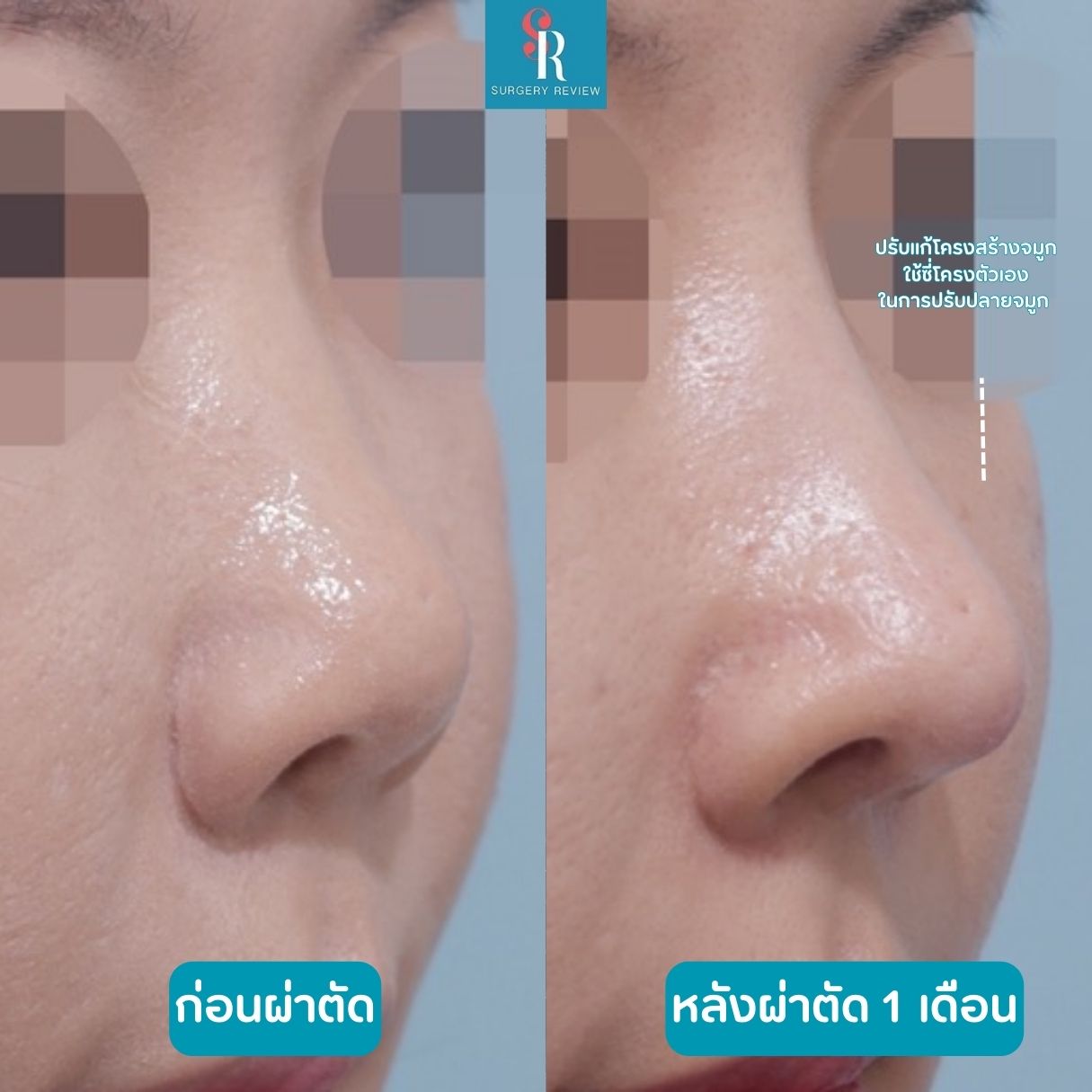 รีวิวรพ.ศัลยกรรม Hanabi(1)