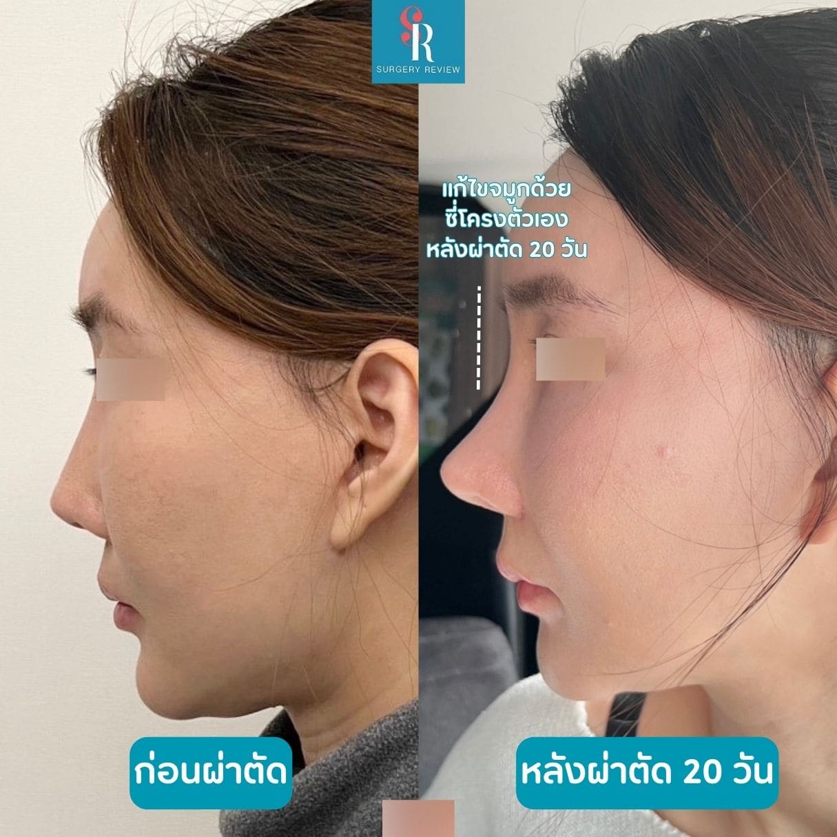 รีวิวรพ.ศัลยกรรม Hanabi(2)
