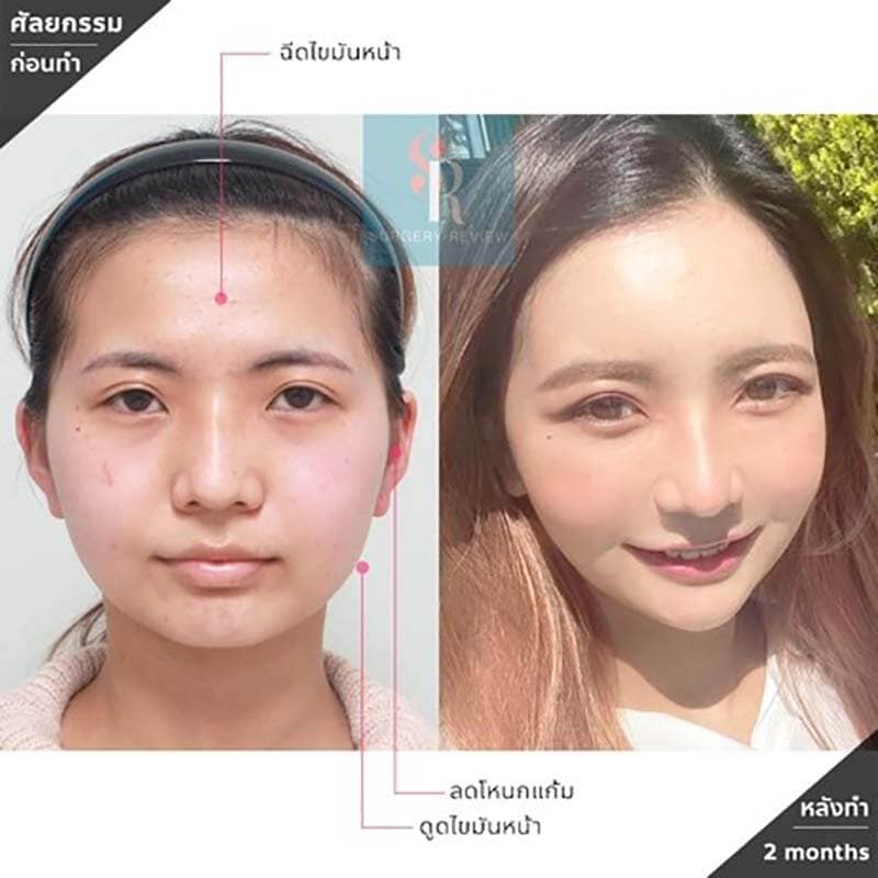 รีวิวลดโหนกแก้ม srsurgery คนไข้จริง