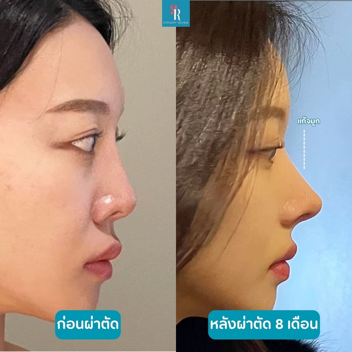 รีวิวศัลยกรรม รพ. Louve 1