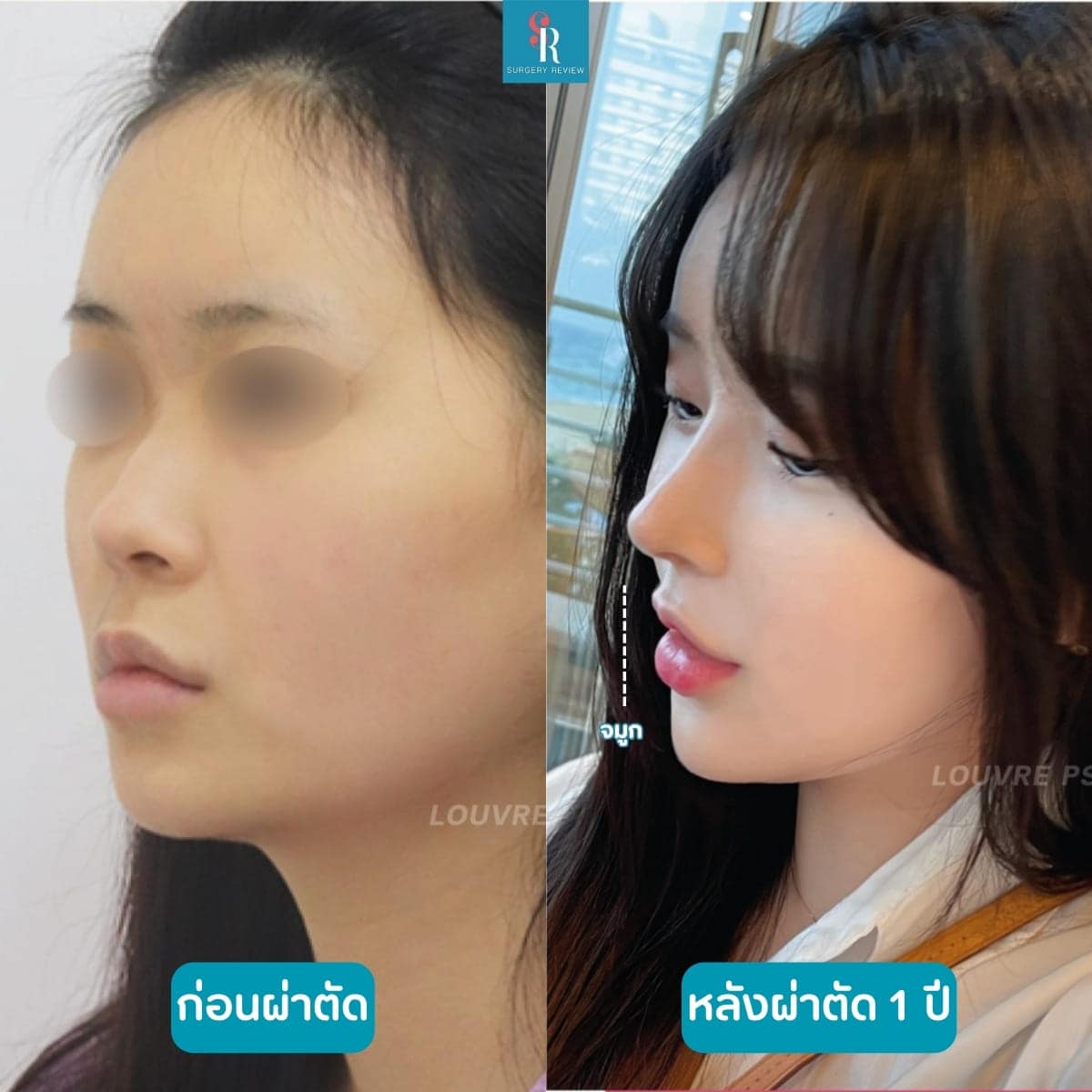 รีวิวศัลยกรรม รพ. Louve 4