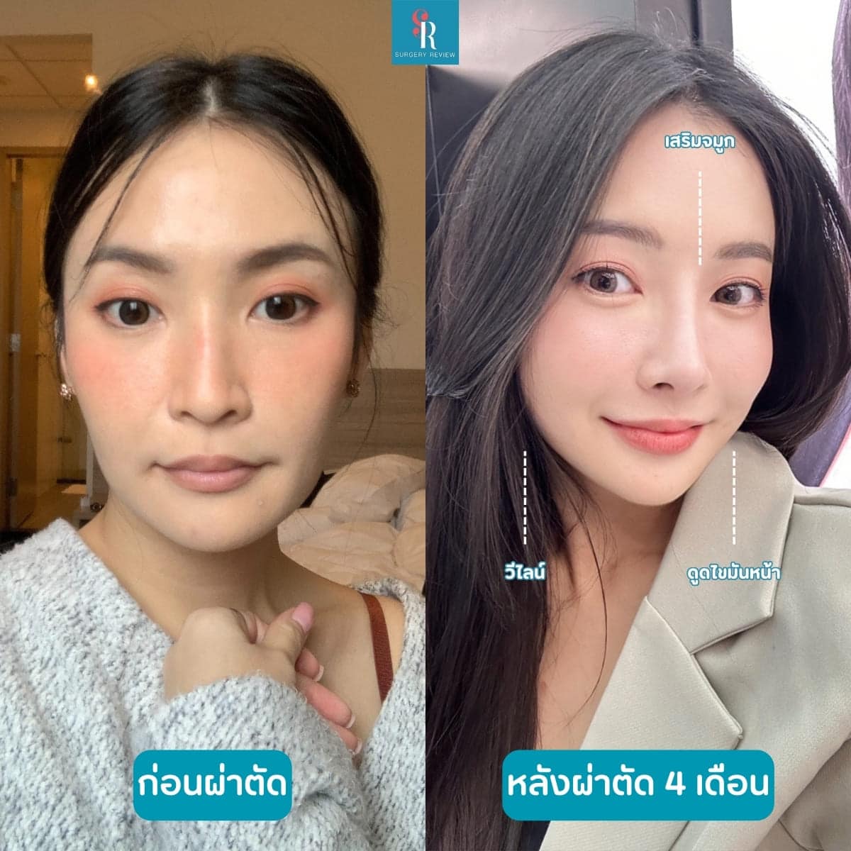 รีวิวศัลยกรรม รพ.Braun วีไลน์+ดูดไขมันหน้า + จมูก