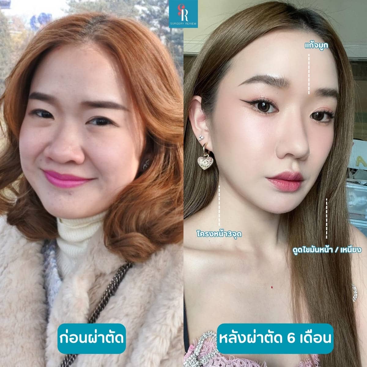 รีวิวศัลยกรรม รพ.Braun โครงหน้า+เสริมจมูก+ดูดไขมันหน้า