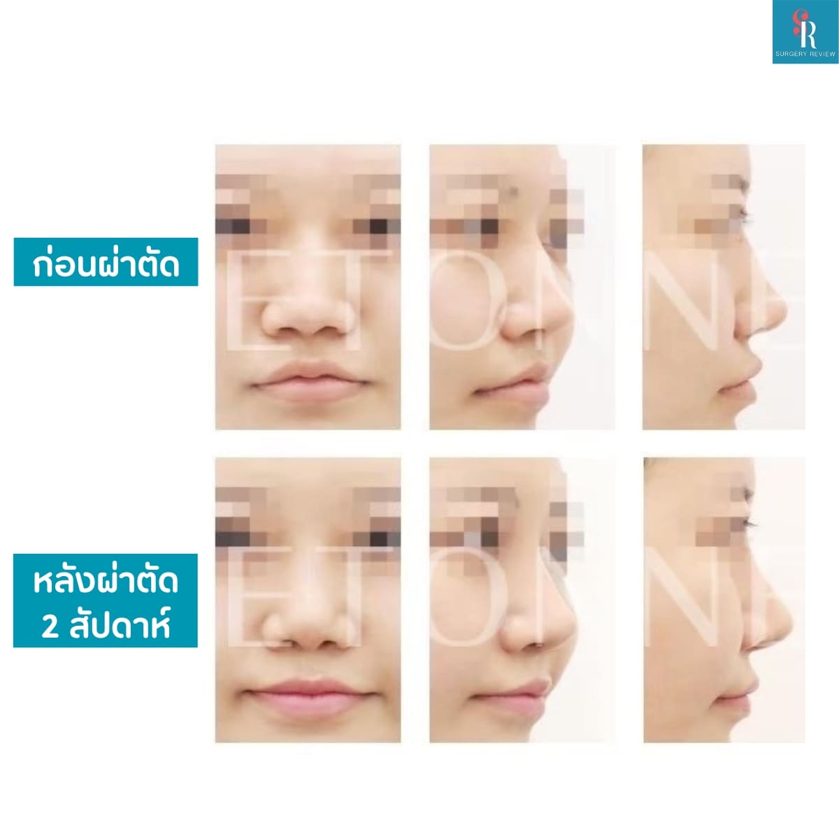 รีวิวศัลยกรรม รพ.Etonne จมูก2