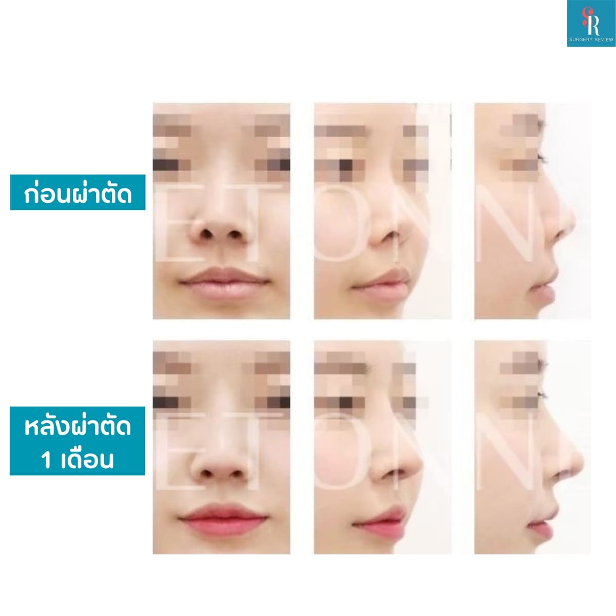 รีวิวศัลยกรรม รพ.Etonne จมูก4