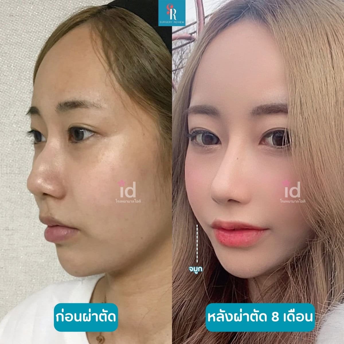 รีวิวศัลยกรรม รพ.ID จมูก