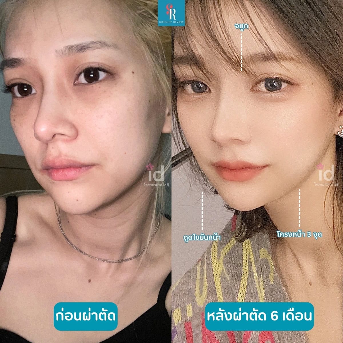 รีวิวศัลยกรรม รพ.ID โครงหน้า+ดูดไขมันหน้า+จมูก