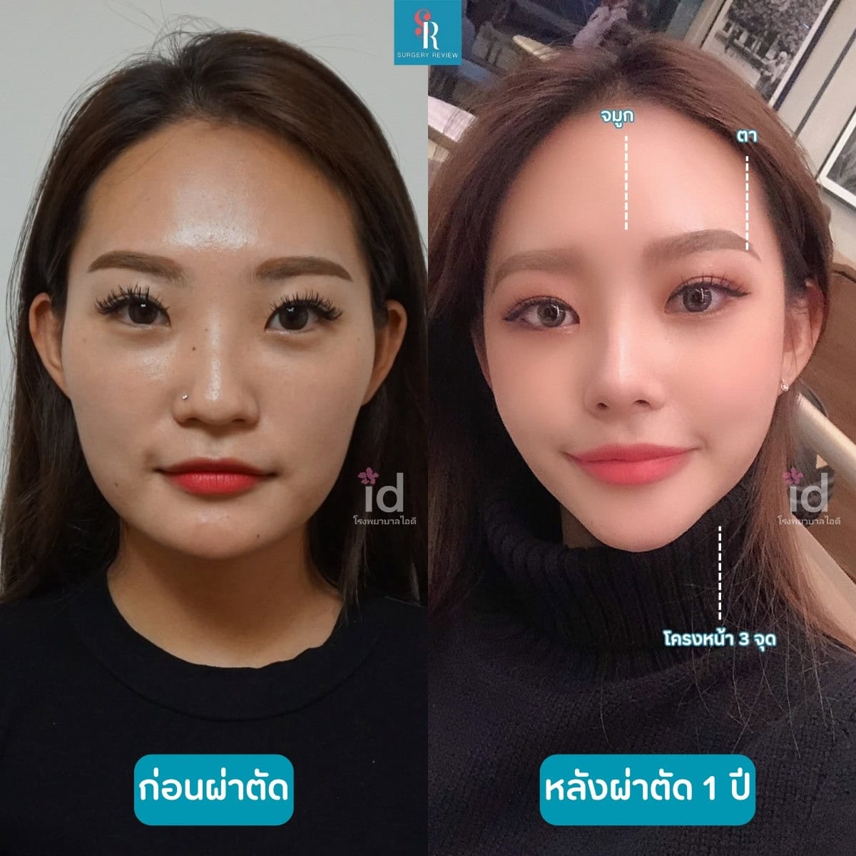 รีวิวศัลยกรรม รพ.ID โครงหน้า+ตา+จมูก