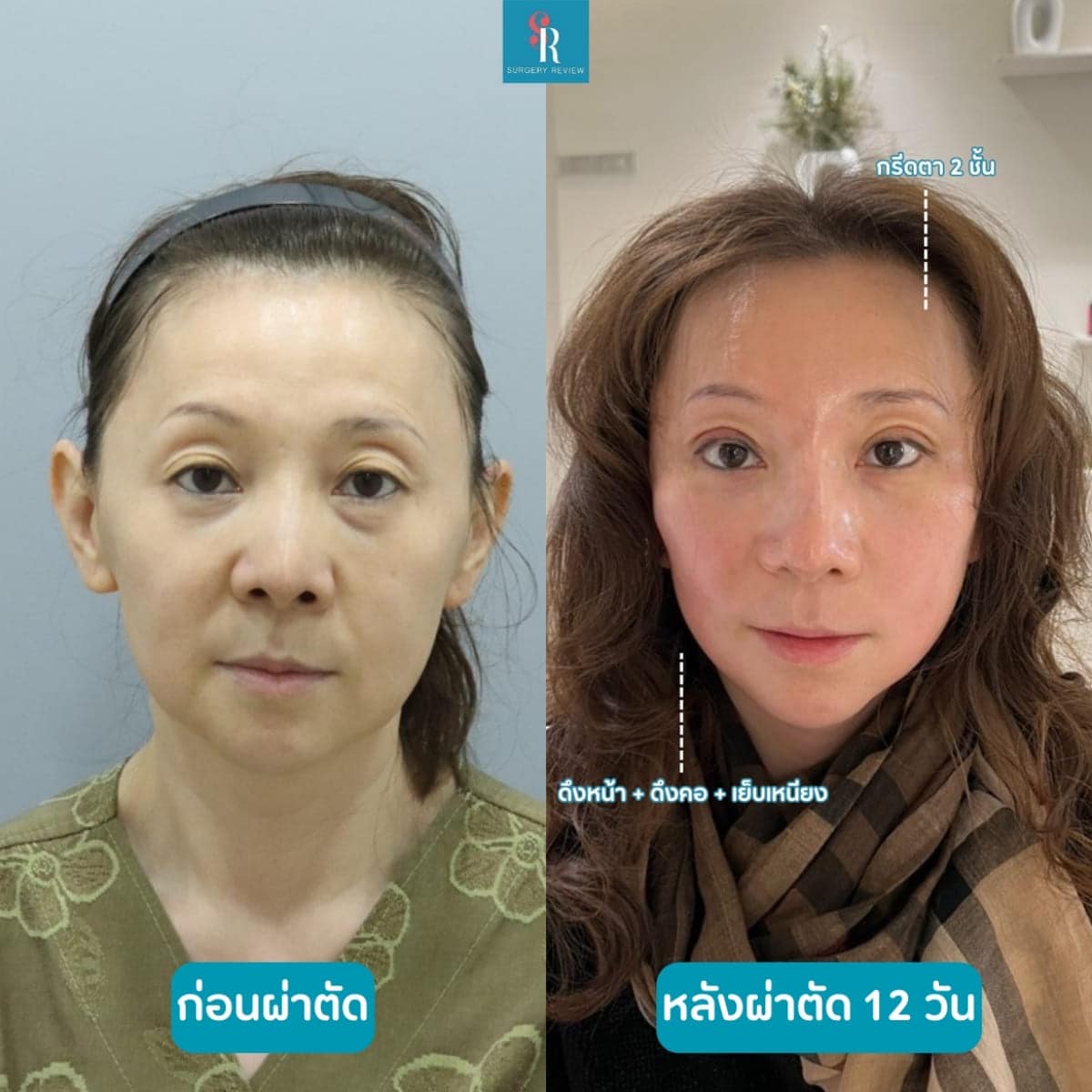 รีวิวศัลยกรรม รพ.Pnaet ดึงหน้า 1