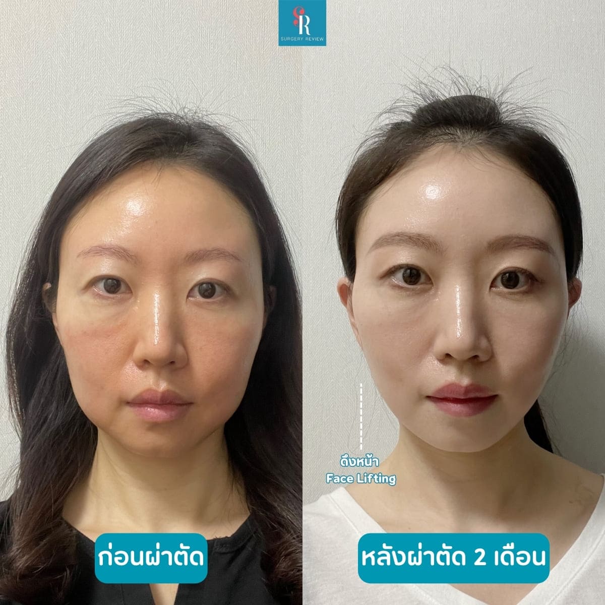 รีวิวศัลยกรรม รพ.Pnaet ดึงหน้า 2