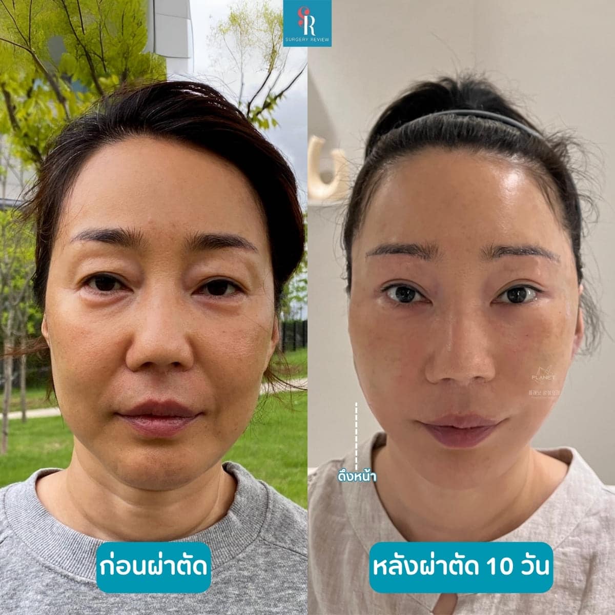 รีวิวศัลยกรรม รพ.Pnaet ดึงหน้า 4