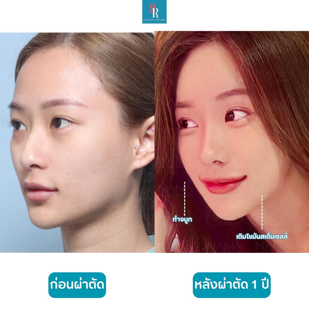 รีวิวศัลยกรรม รพNana จมูก+เติมไขมัน