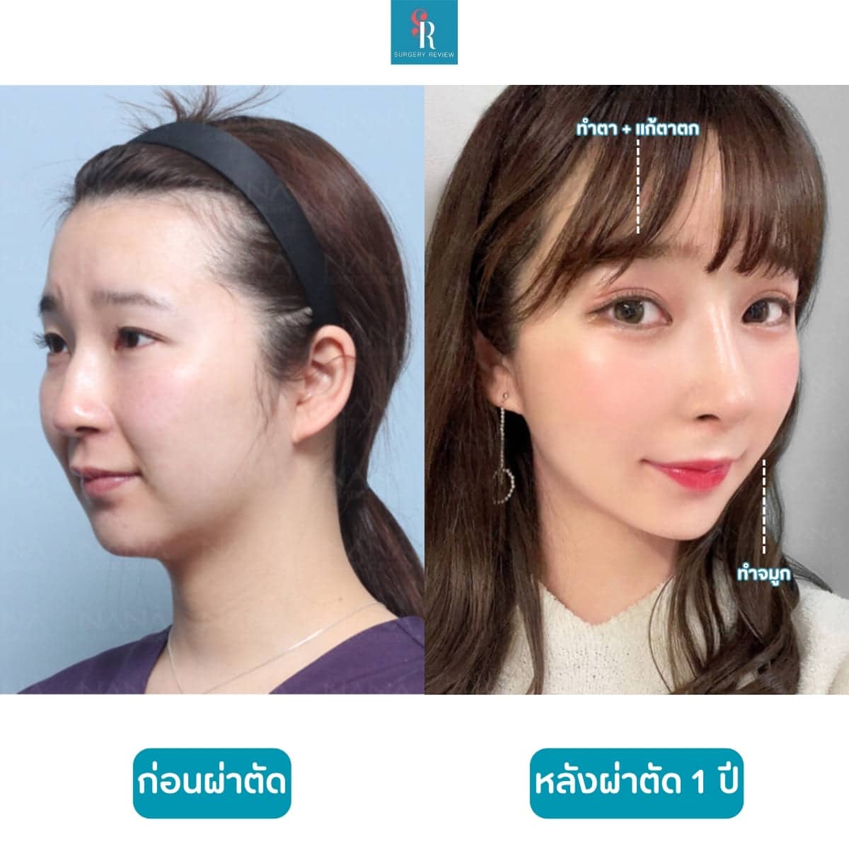 รีวิวศัลยกรรม รพNana ตา+จมูก