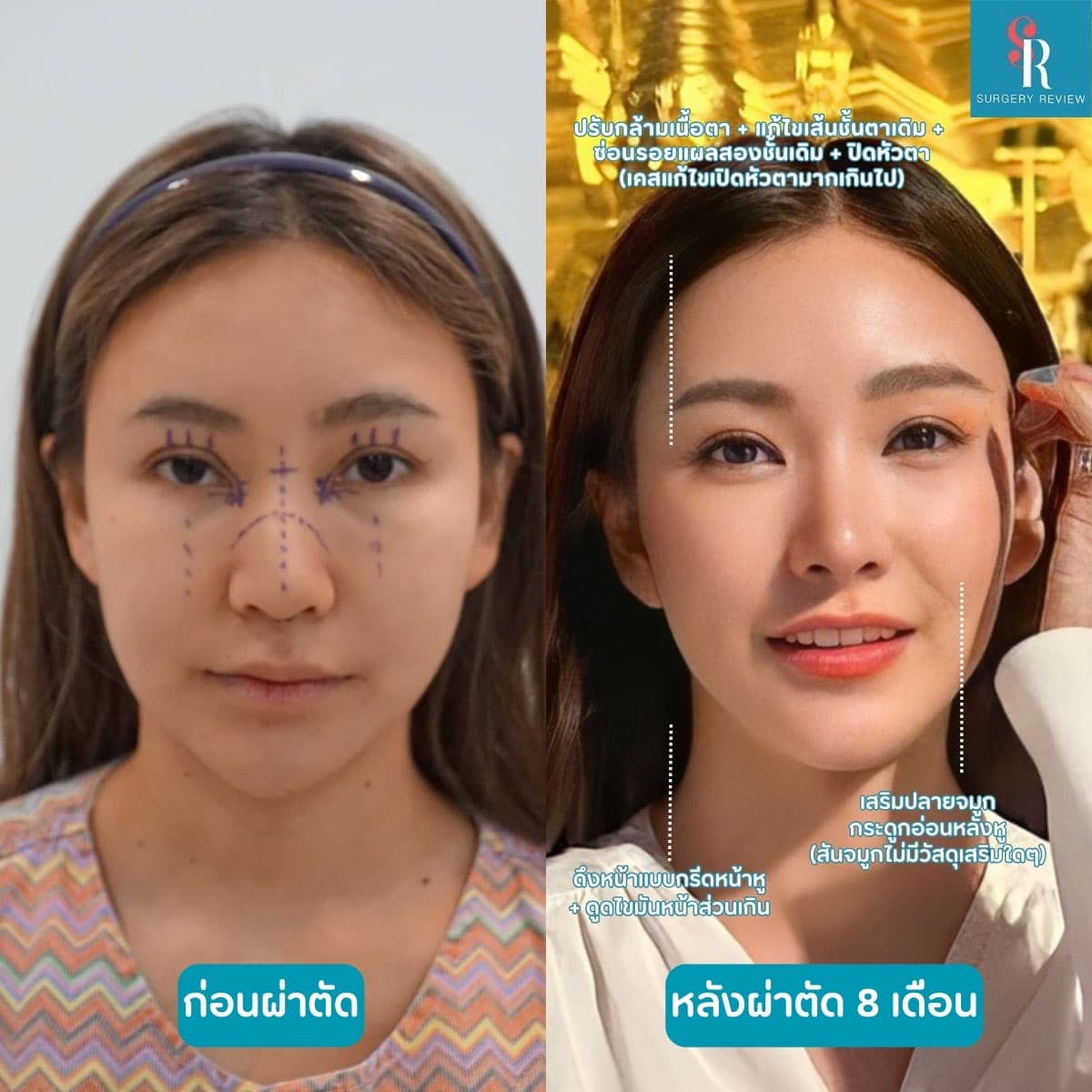 รีวิวศัลยกรรมก่อนหลัง-ที่-รพ-Sui