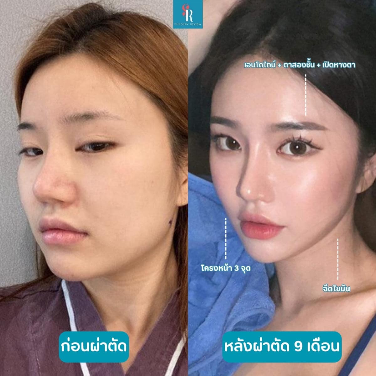 รีวิวศัลยกรรมรพ.AB โครงหน้า3จุด+ฉีดไขมัน+เอนโดไทน์+ตา