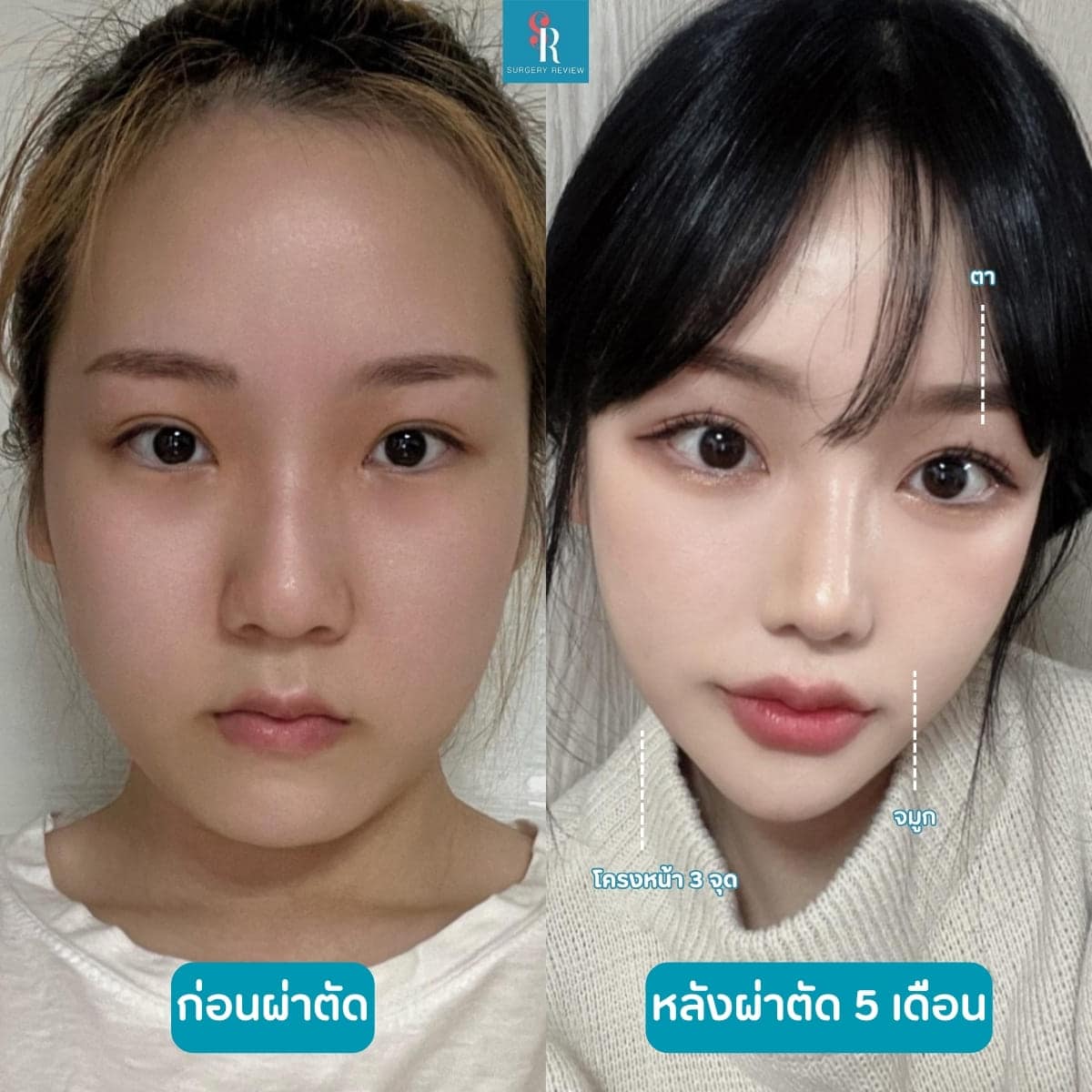 รีวิวศัลยกรรมรพ.AB โครงหน้า3จุด+ตา+จมูก
