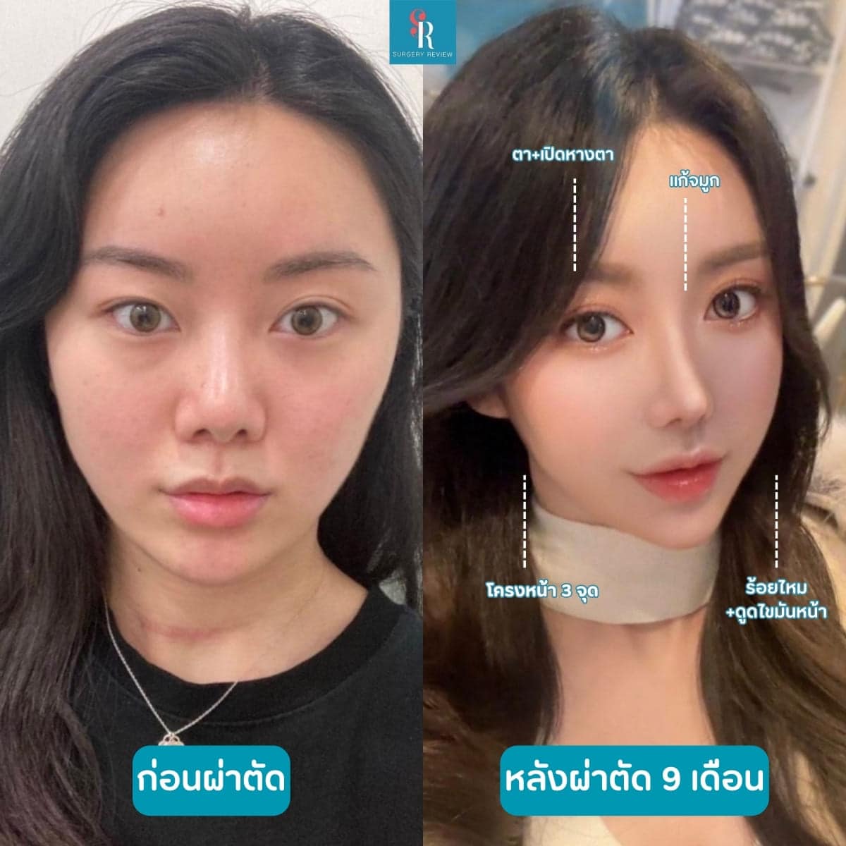 รีวิวศัลยกรรมรพ.AB โครงหน้า+ตา+ร้อยไหม+แก้จมูก+ดูดไขมัน