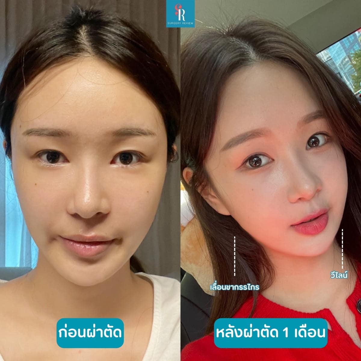 รีวิวศัลยกรรมรพ.EU เลื่อนขากรรไกร+วีไลน์ 3