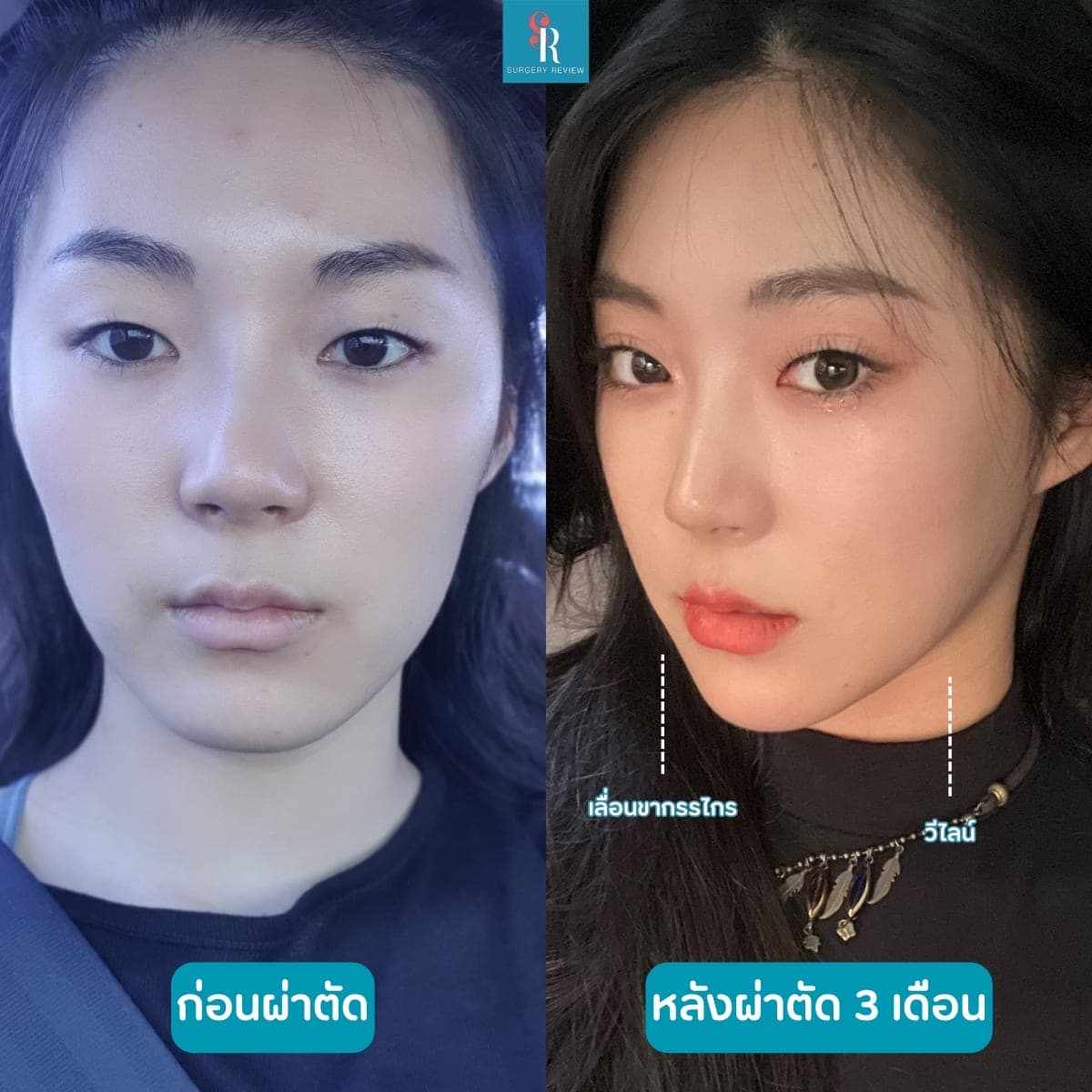 รีวิวศัลยกรรมรพ.EU เลื่อนขากรรไกร+วีไลน์ 4