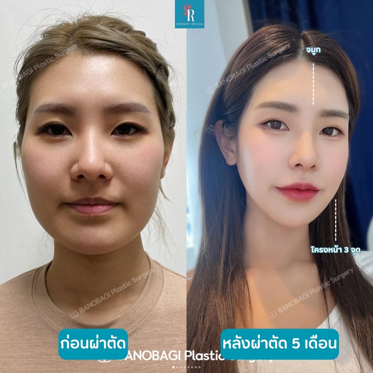 รีวิวศัลยกรรมรพ.banobagi โครงหน้า3จุด + จมูก