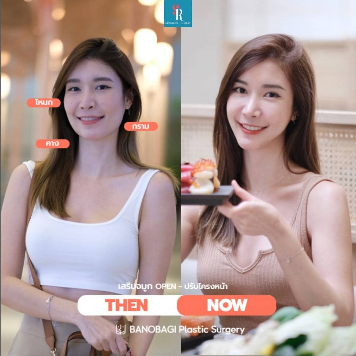 รีวิวศัลยกรรมรพ.banobagi โครงหน้า3จุด