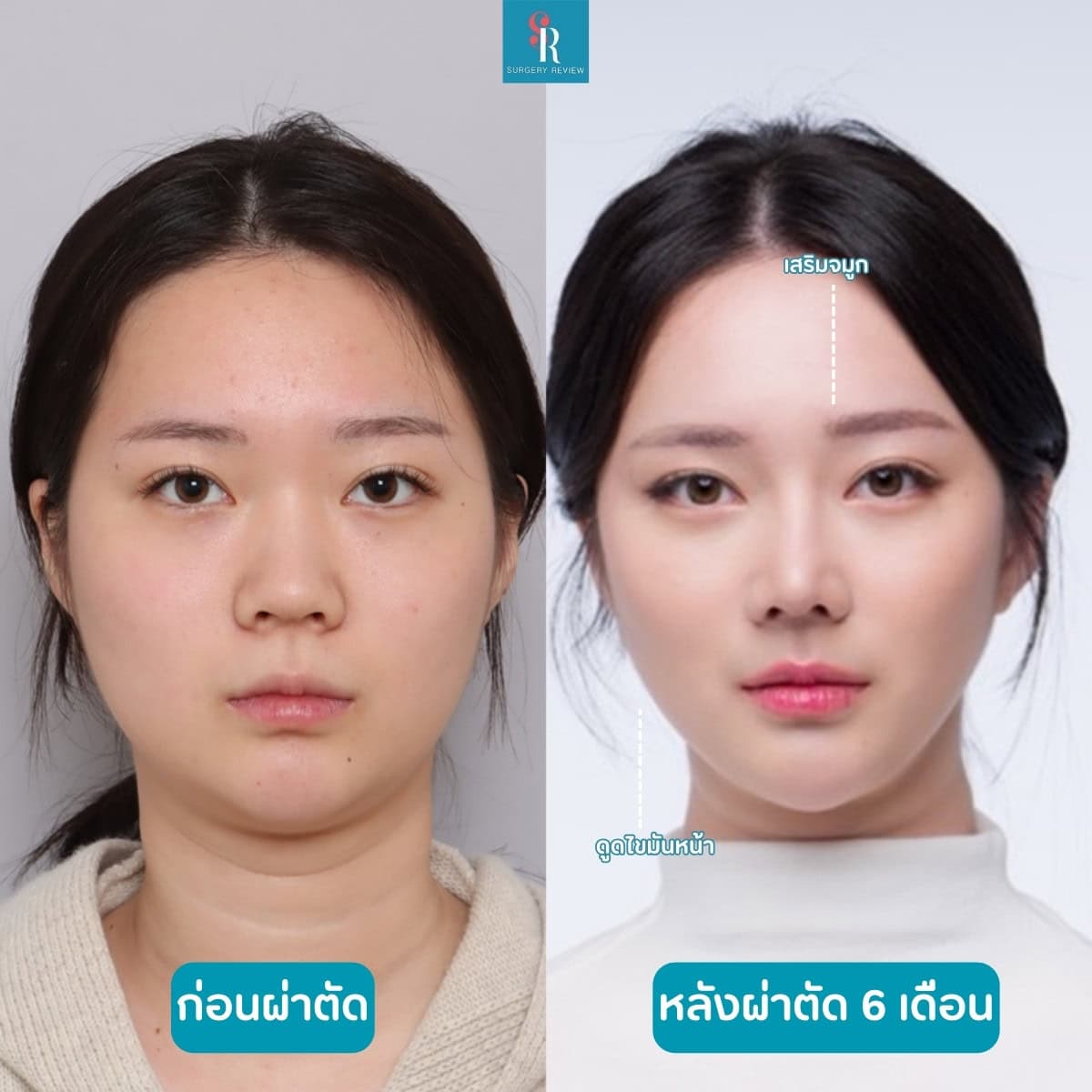 รีวิวศัลยกรรมรพ.dream ดูดไขมันหน้า + จมูก