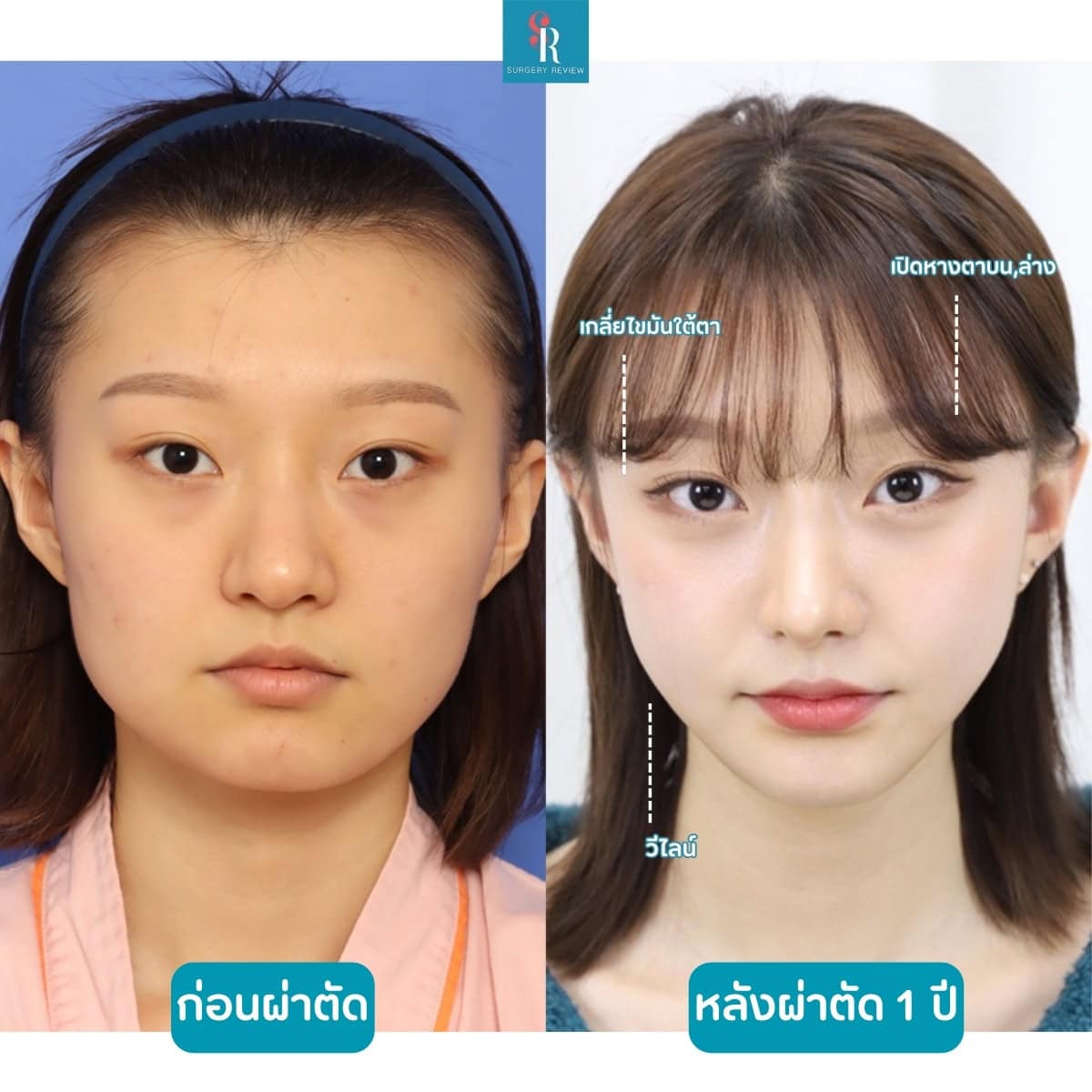 รีวิวศัลยกรรมรพ.dream วีไลน์+ตา