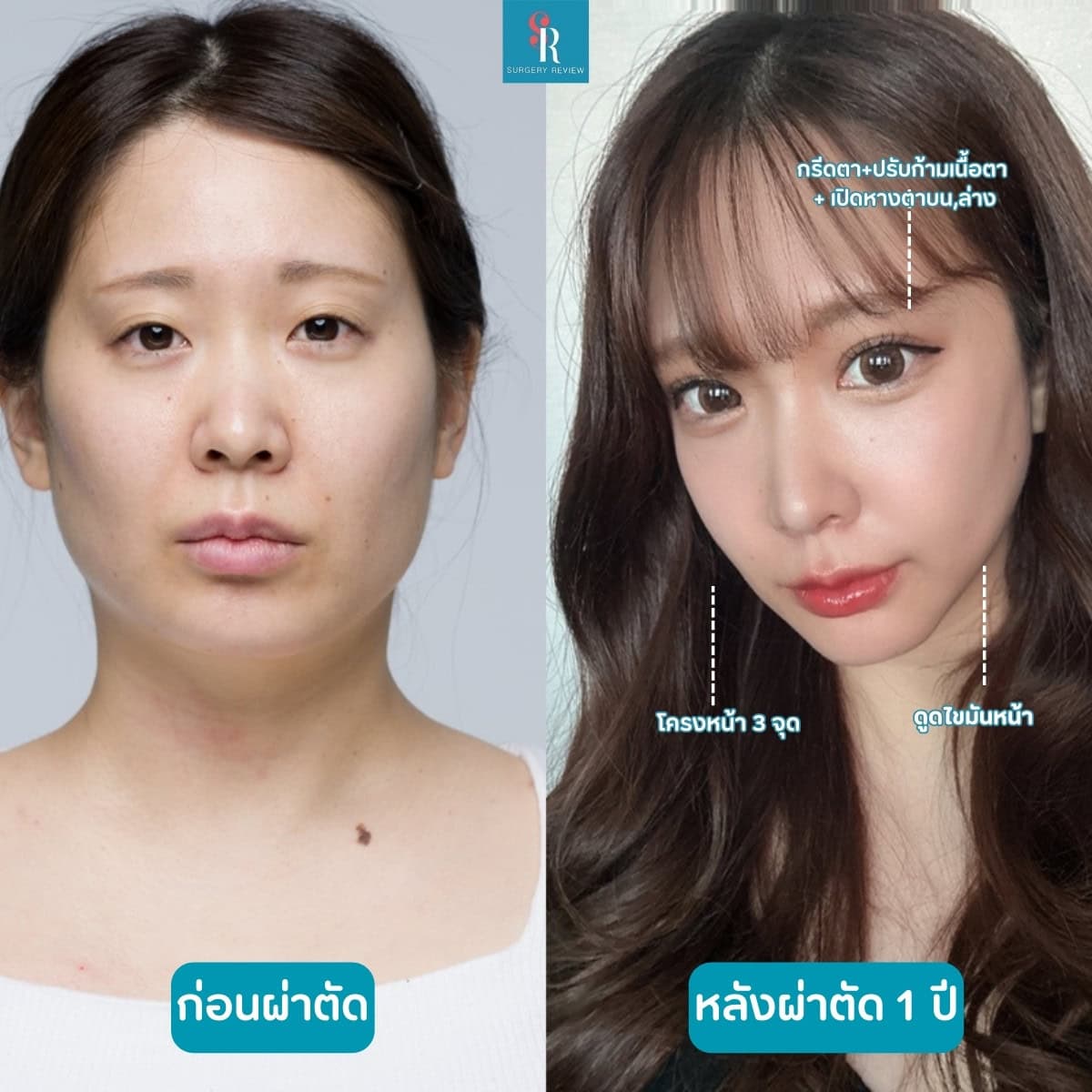 รีวิวศัลยกรรมรพ.dream โครงหน้า3จุด+ดูดไขมันหน้า+ตา