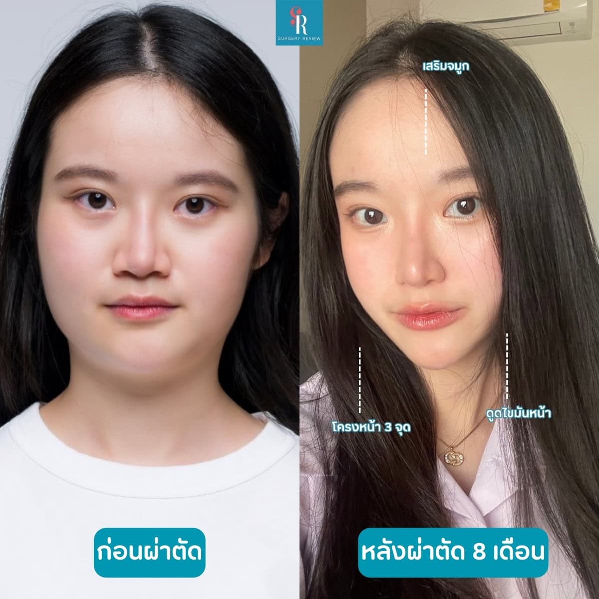 รีวิวศัลยกรรมรพ.dream โครงหน้า3จุด+ดูดไขมันหน้า+ตา