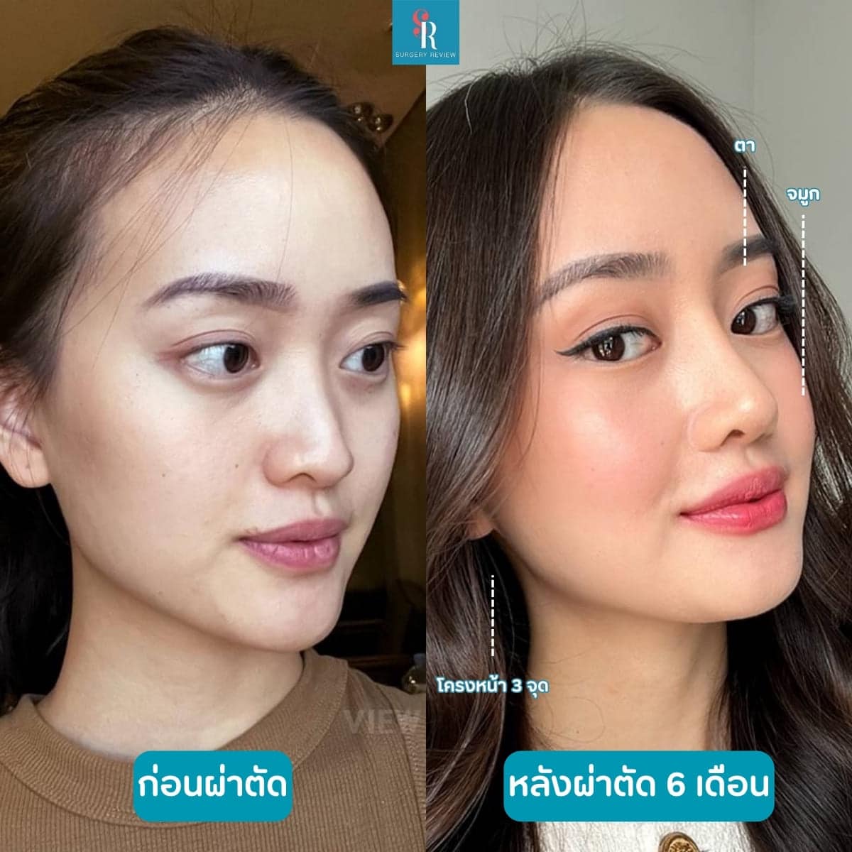 รีวิวศัลยกรรมรพ.view โครงหน้า+ตา+จมูก