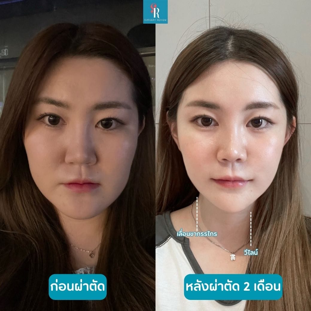 ีรีวิวรพ.ศัลยกรรม Seoulface21