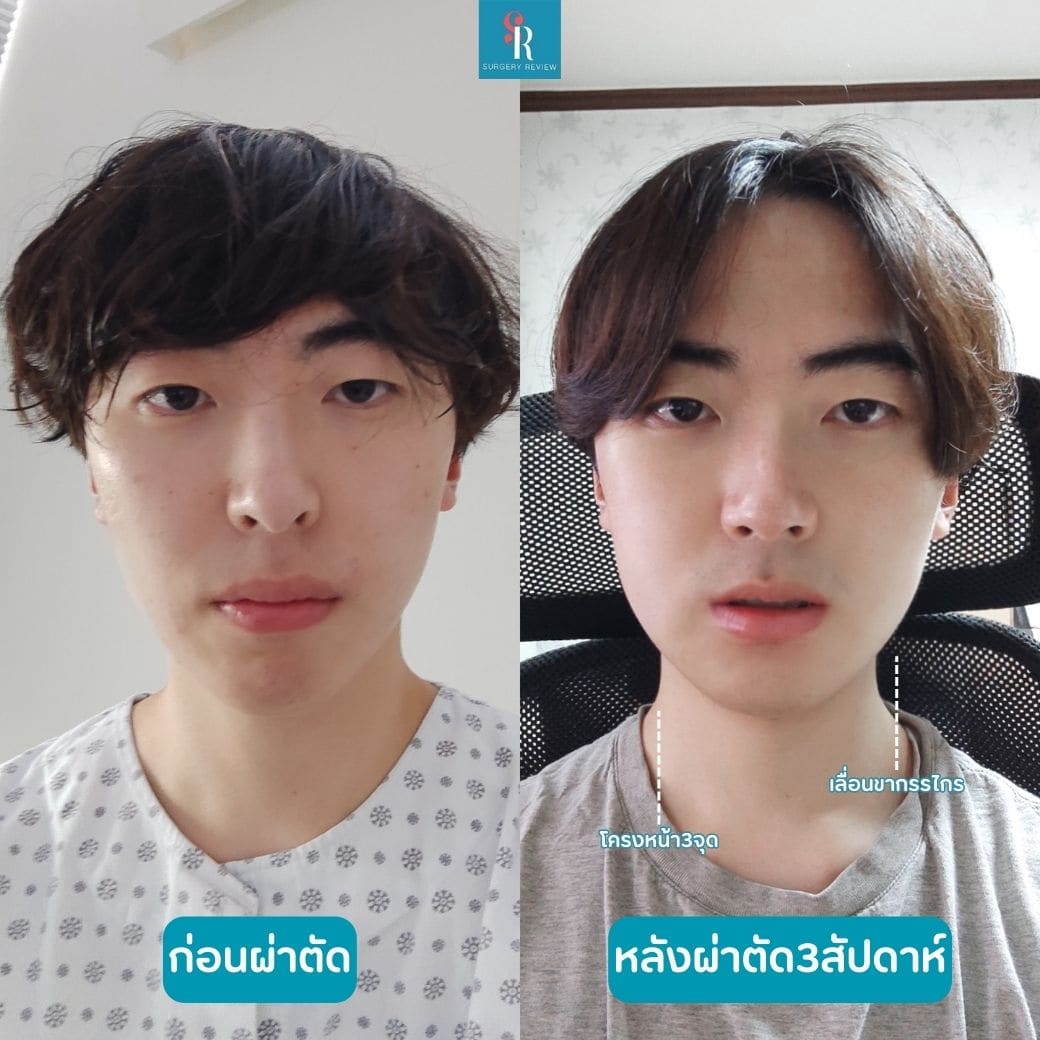 ีรีวิวรพ.ศัลยกรรม Seoulface21(1)