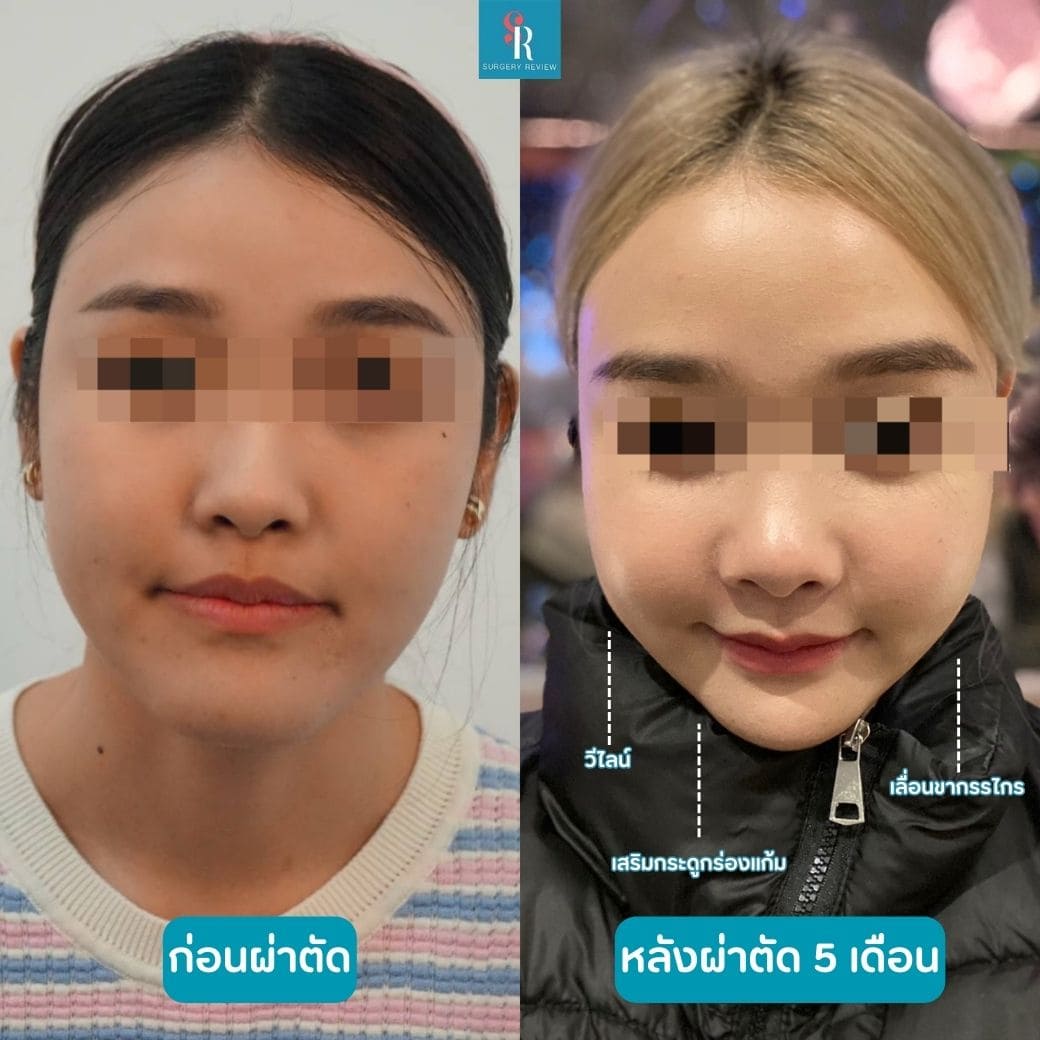 ีรีวิวรพ.ศัลยกรรม Seoulface21(3)
