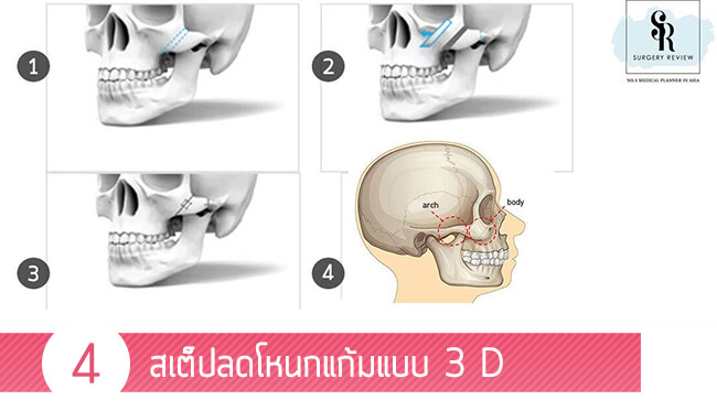 4สเต็ปลดโหนกแก้ม3D